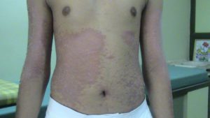 Psoriasis Treatment by Homoeopathy